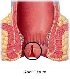 Anal fissure
Early diagnosed fissure healed its... main image