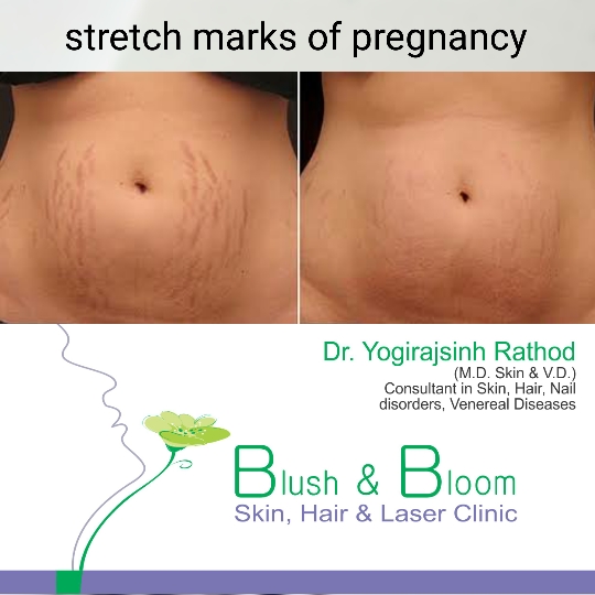 Get rid of stretch marks.....
Think_Skin_Think_... main image