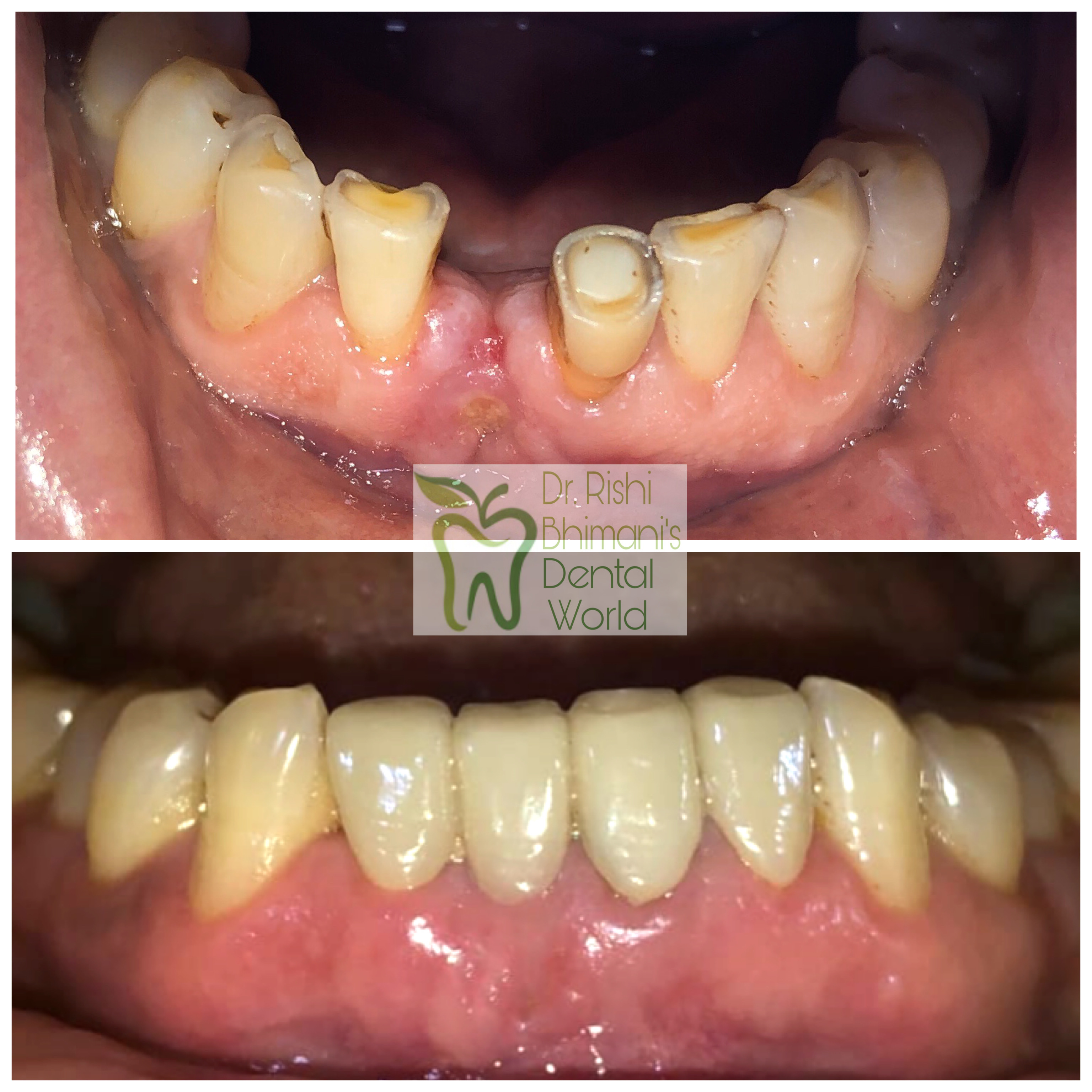 CROWN & BRIDGE
MISSING TEETH & DECAYED TEETH ca... main image