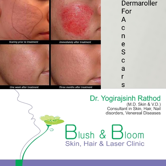 Get rid of acne scars.....
Think_Skin_Think_Blush_... main image