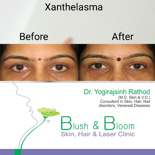  xanthelasma removal......
Think_Skin_Think_Blush_... main image