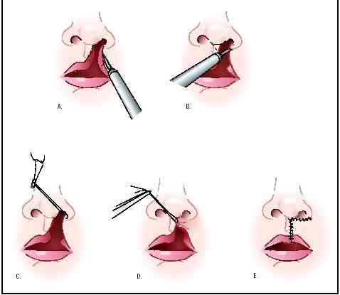 Cleft lip surgery......
Liposuction 
Rhinoplasty 
... main image