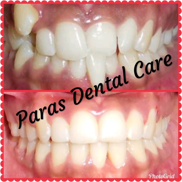 Braces not only help to correct the alignment o... main image