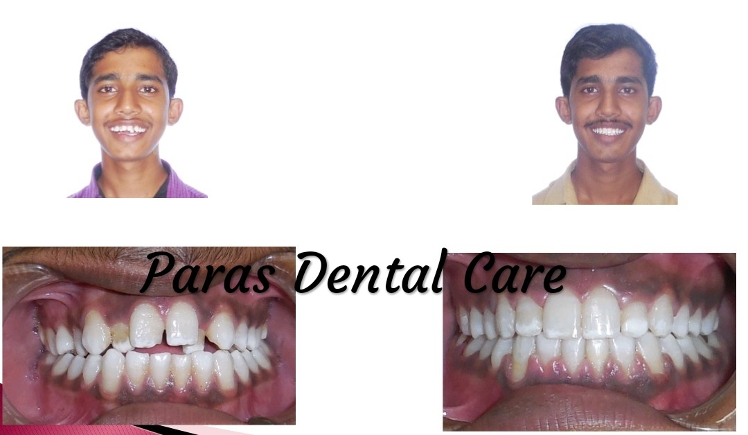 Orthodontic treatment correct irregularities of... main image