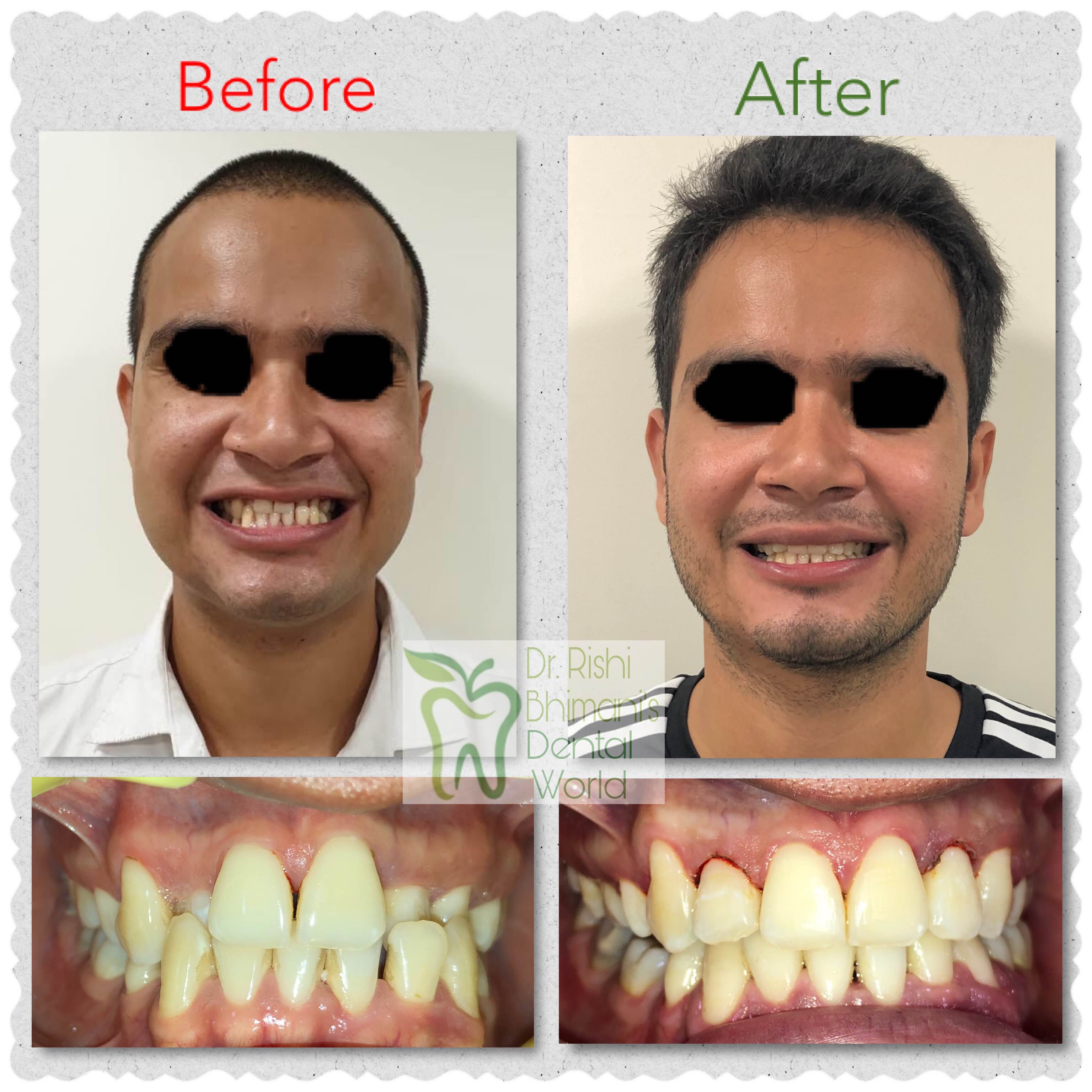 TEETH BRACES
Correction of CROWDED TEETH, IRREG... main image
