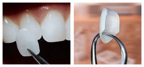 Dental Veneers can close spaces in between teet... main image
