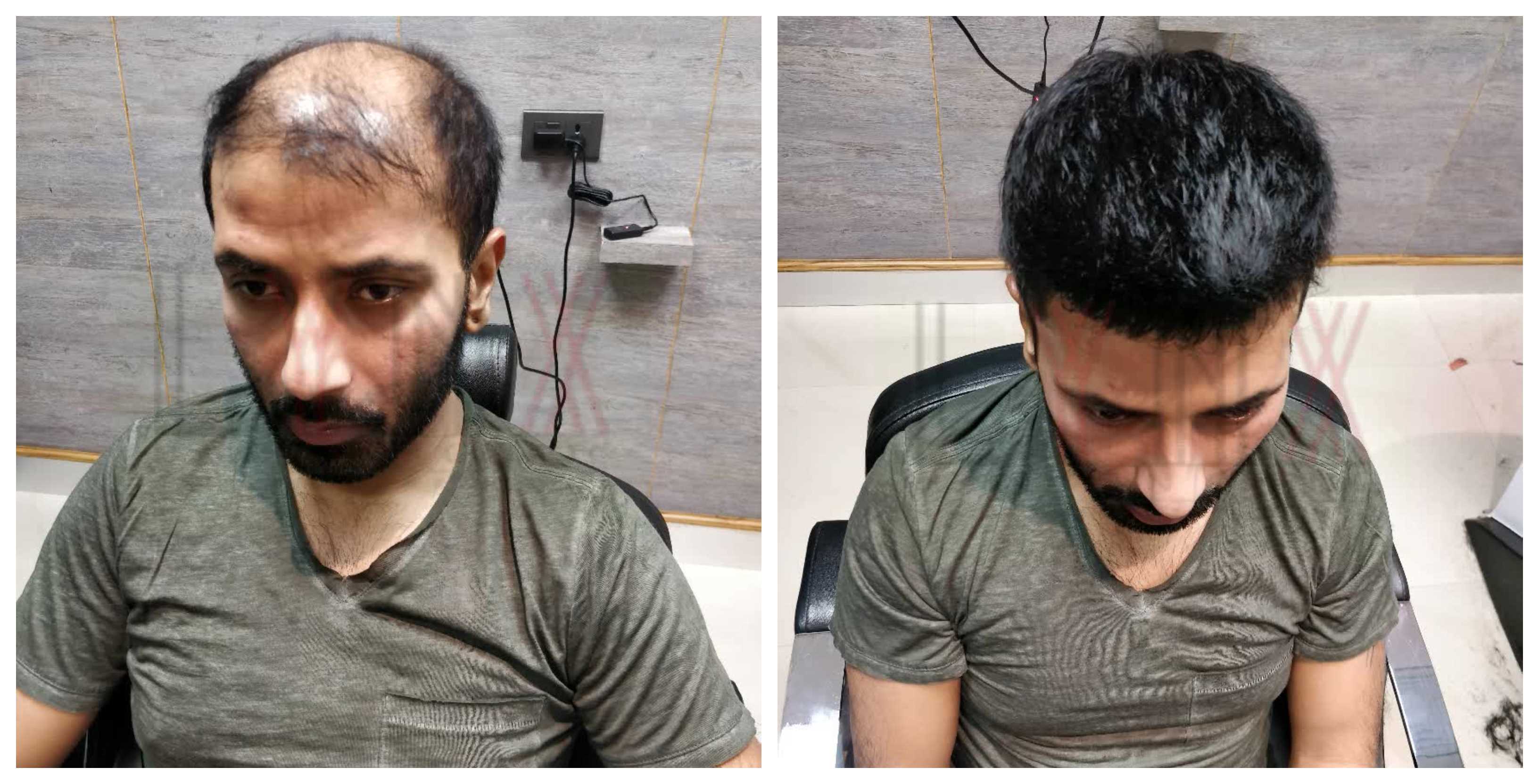 Hair Bonding In Bihari Colony Delhi Generall Hair Wigs Weaving