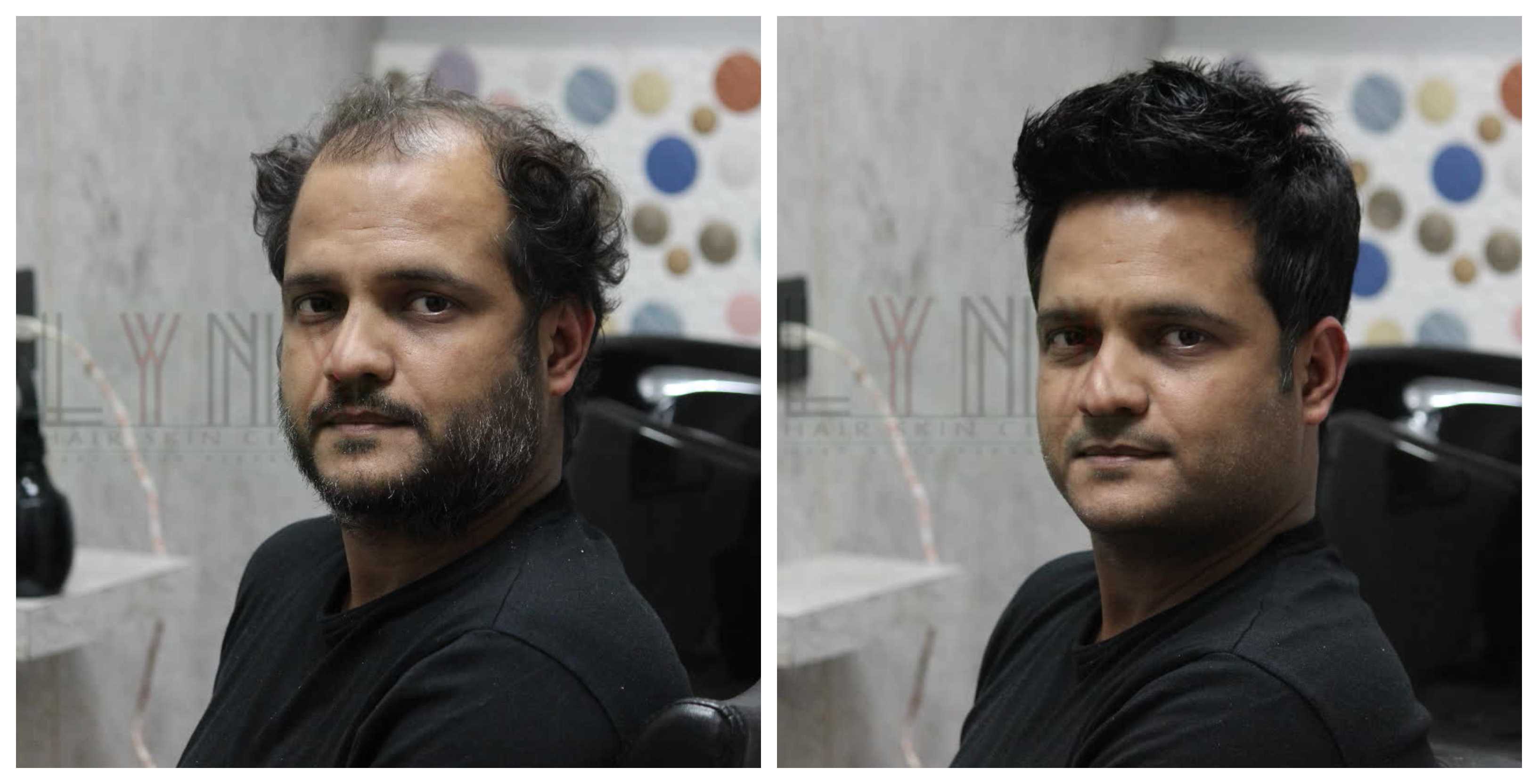 Hair Bonding In Chhajjupur Delhi Generally Hair Wigs Weaving