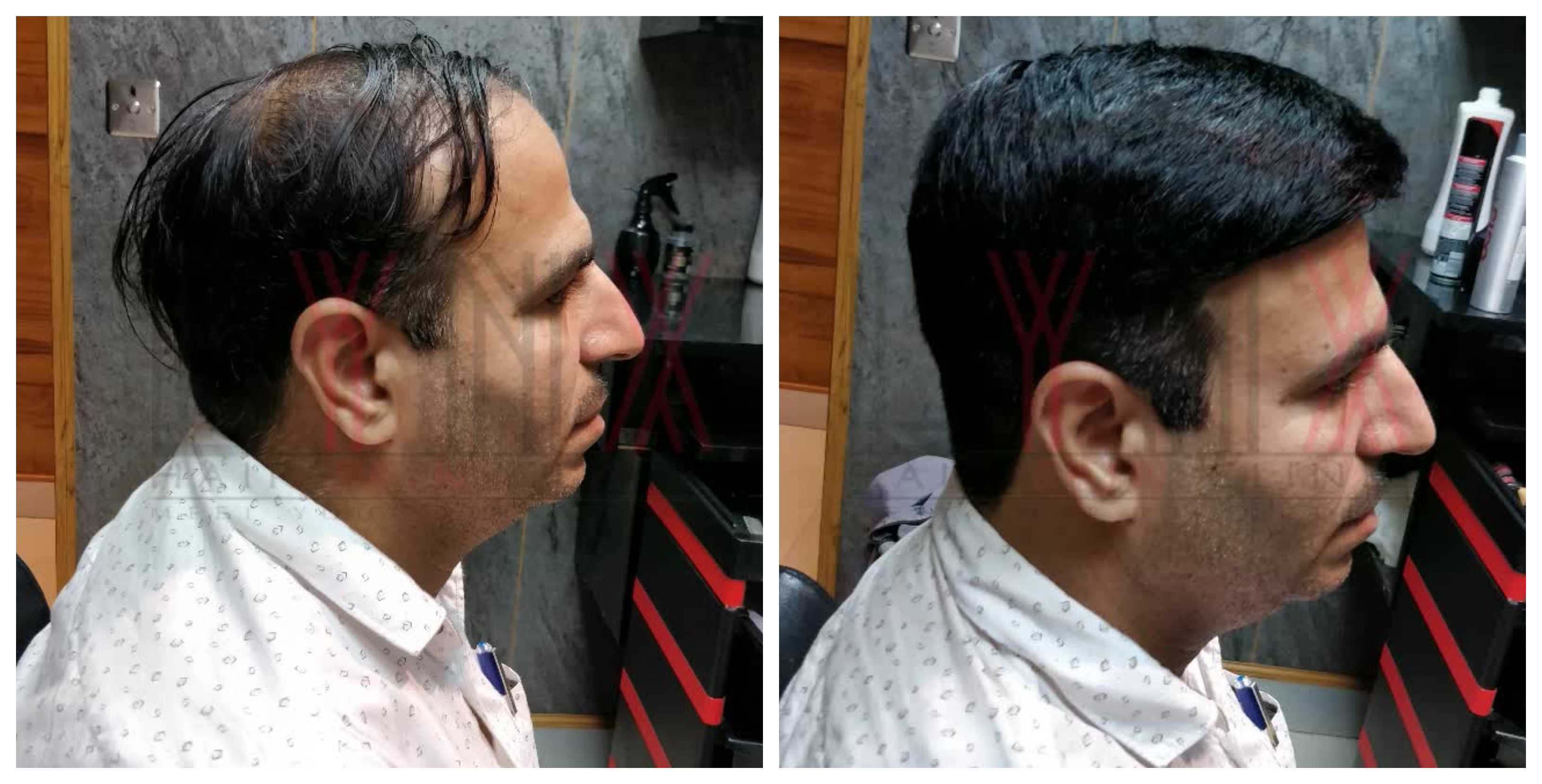 Hair Bonding In Diplomatic Enclave Delhi Gen Hair Wigs Weaving