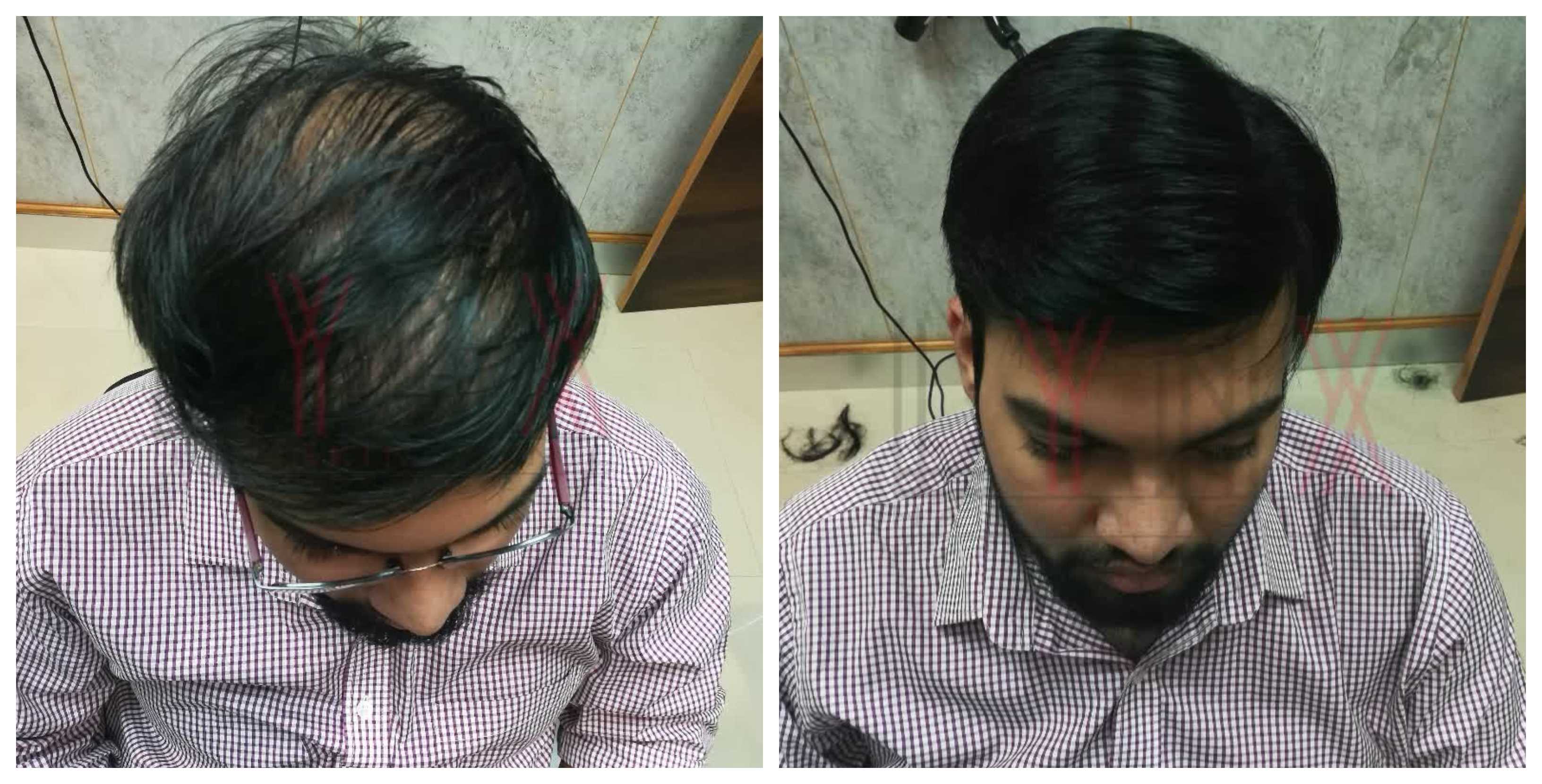 Hair Bonding In Gautam Vihar Delhi Generally Hair Wigs Weaving