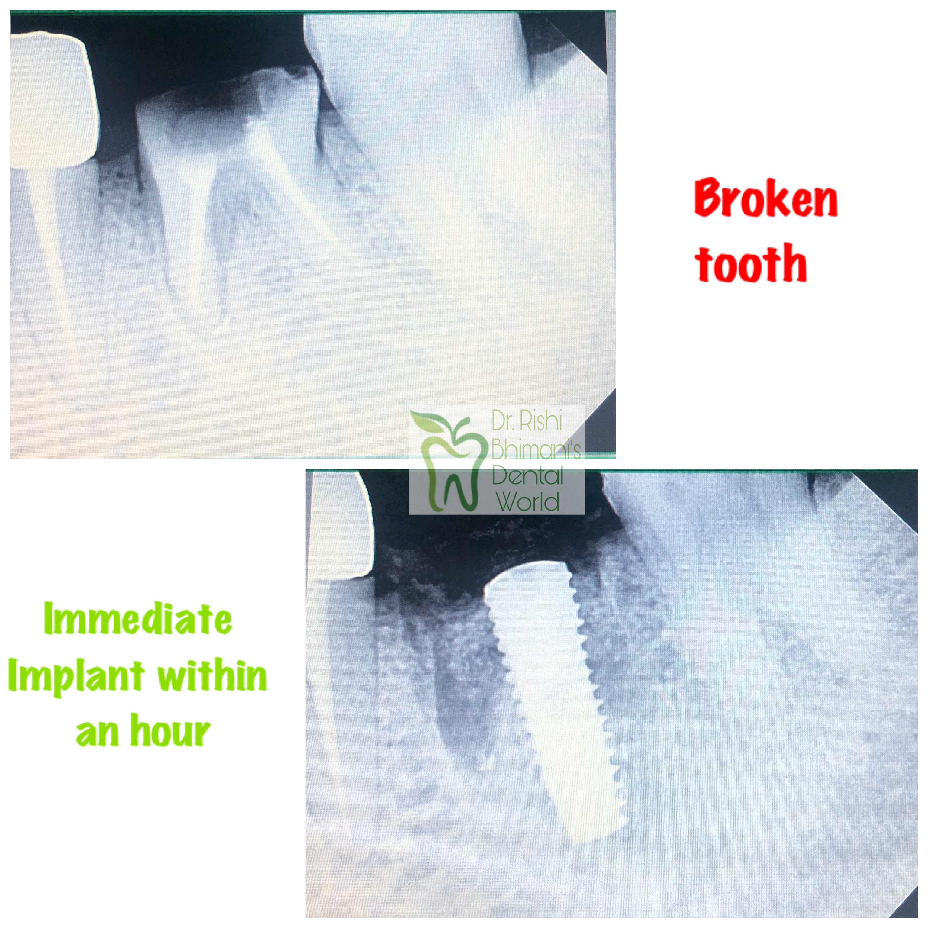 DENTAL IMPLANTS
DENTAL IMPLANTS can replace a s... main image