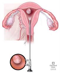 Hysteroscopy is a procedure that allows your do... main image