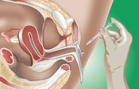 IUI- Intrauterine Insemination

The term Infert... main image