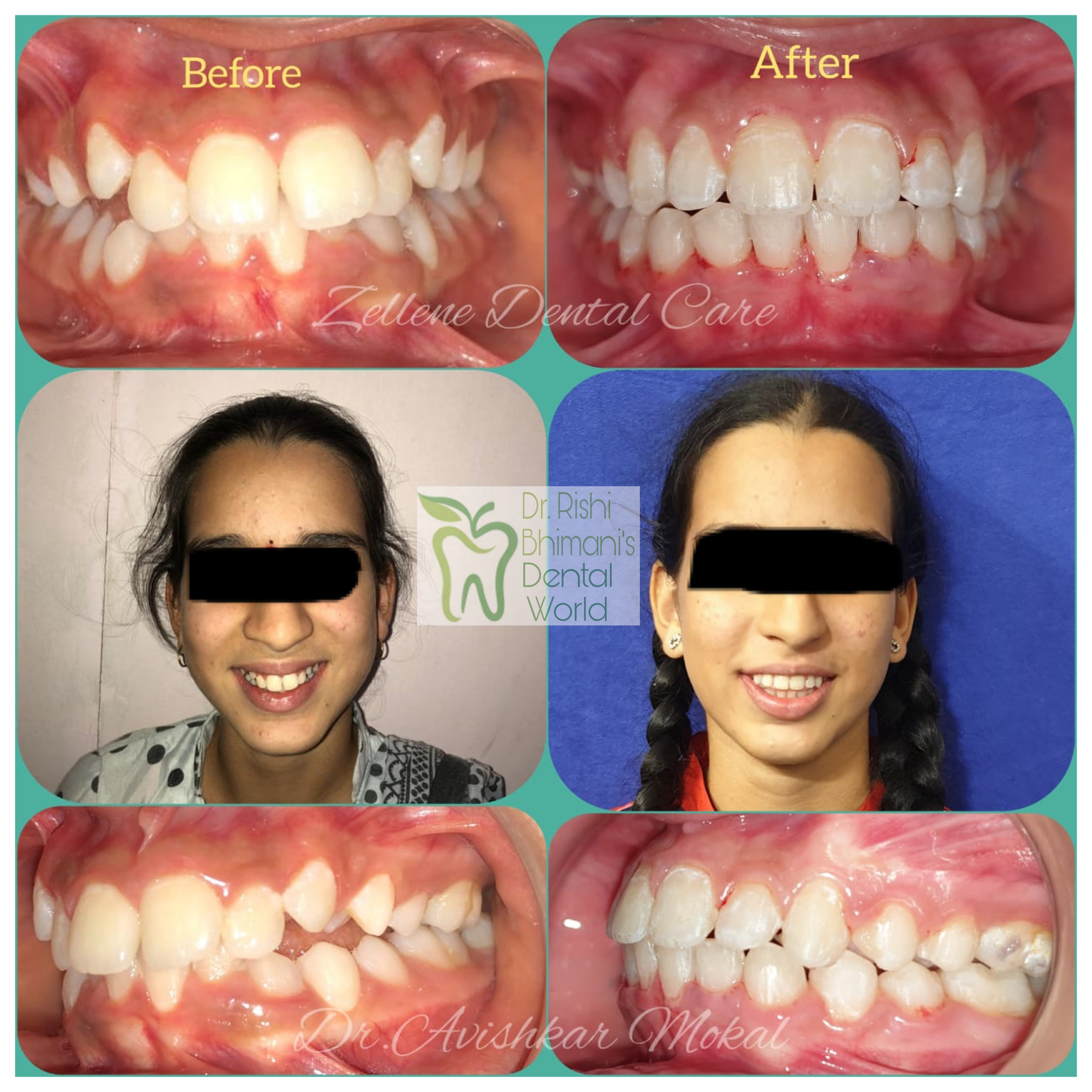 TEETH BRACES
Correction of CROWDED TEETH, IRREG... main image