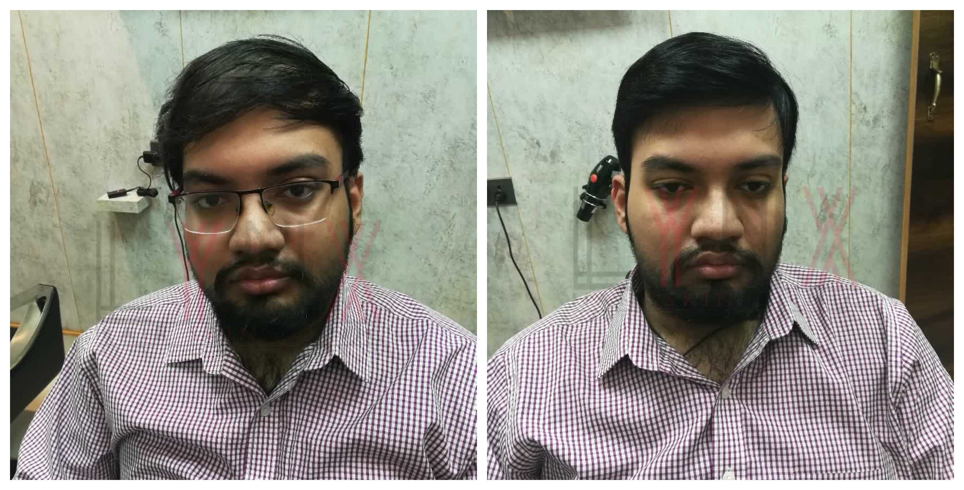 Hair Bonding In Mandakini Enclave Colony Delh Hair Wigs Weaving