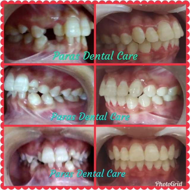Crowded teeth and missing teeth not only have i... main image