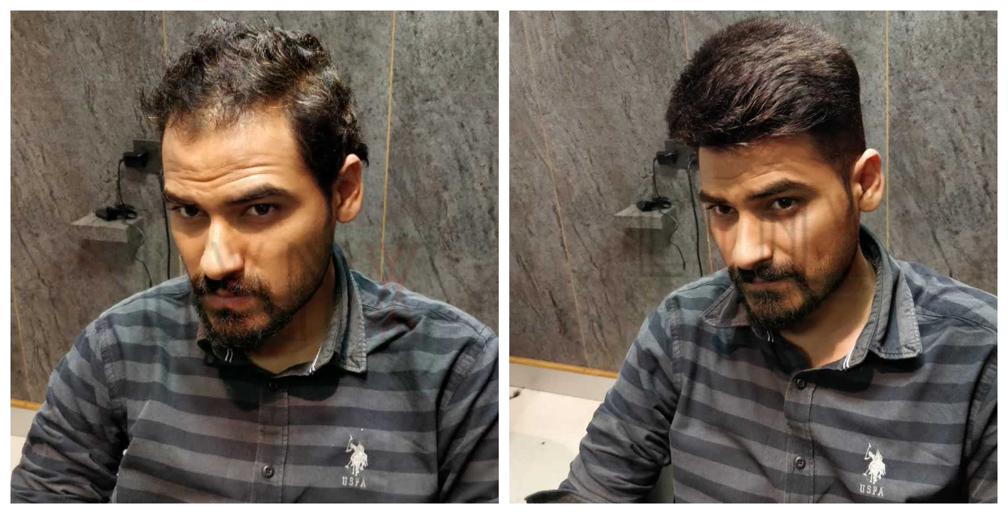 Hair Bonding In Sector 24 Rohini Delhi Gener Lynx Hair Skin Clinic