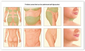 Liposuction 
Rhinoplasty 
Implants 
Tummytuck 
Gyn... main image