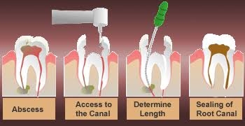 Root canal treatment (RCT) is the removal of th... main image