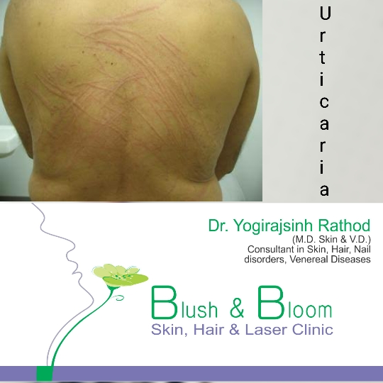 Skin_allegy
Urticaria
Think_Skin_Think_Blush_& _Bl... main image