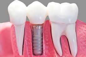 Loss of natural tooth not only influence oral func... main image