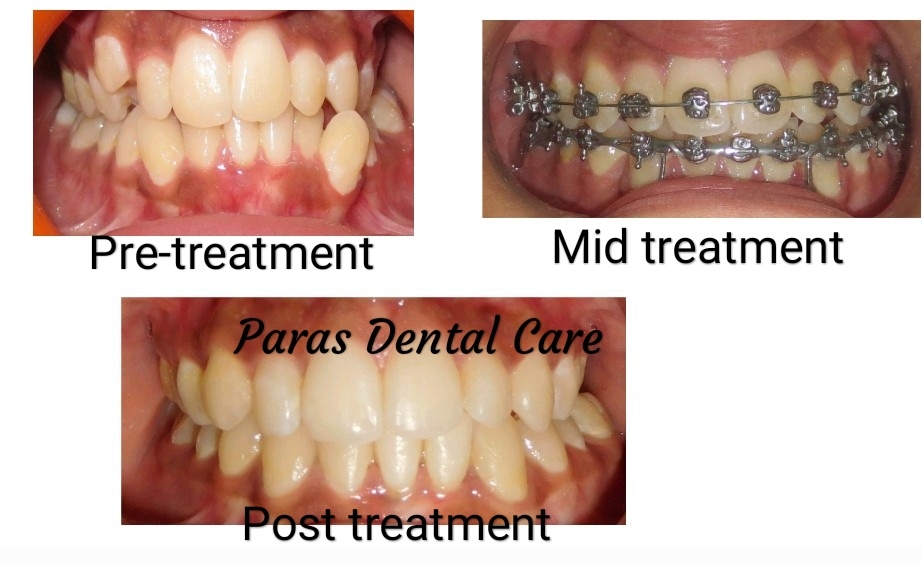 Dental braces are the best treatment option to ... main image