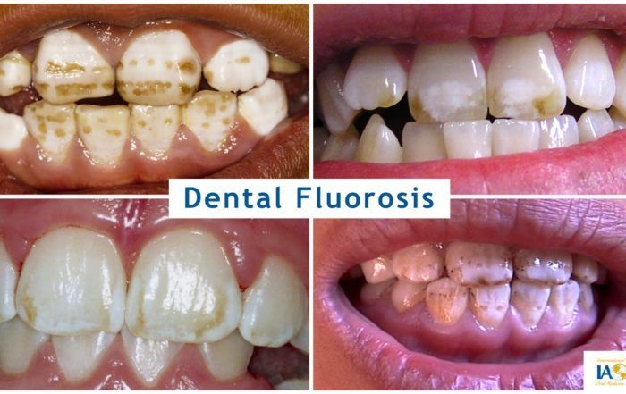 Dental fluorosis is due to consuming too much f... main image