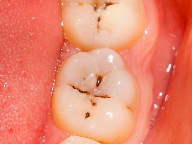 If a Dental Decay is left untreated, it will lead ... main image
