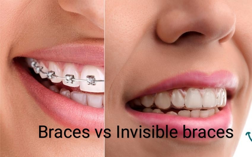INVISIBLE BRACES ARE SO CLEAR, NO ONE WILL KNOW... main image