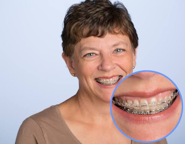 Can teeth be straightened at any age?

There is... main image