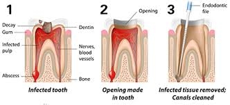 Root canal treatment(RCT) can save your natural... main image