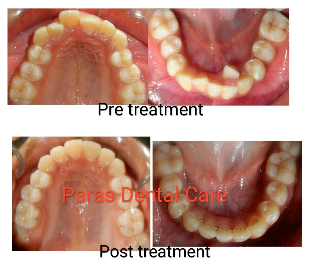 Orthodontic Case
Irregular or crowded teeth cas... main image