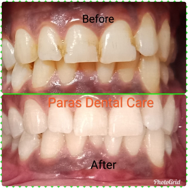 Teeth whitening is a treatment that enhance tee... main image