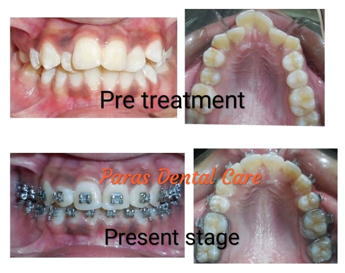 Patient presented to us with severe crowding in he... main image