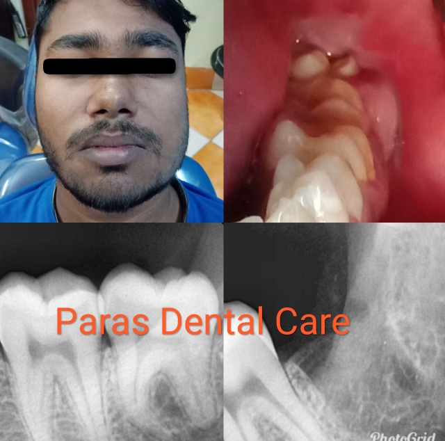 Extraction of wisdom tooth is required or not??... main image