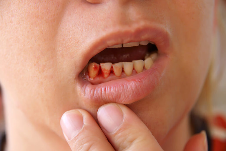 BLEEDING GUMS is the first sign of GUM DISEASE.... main image