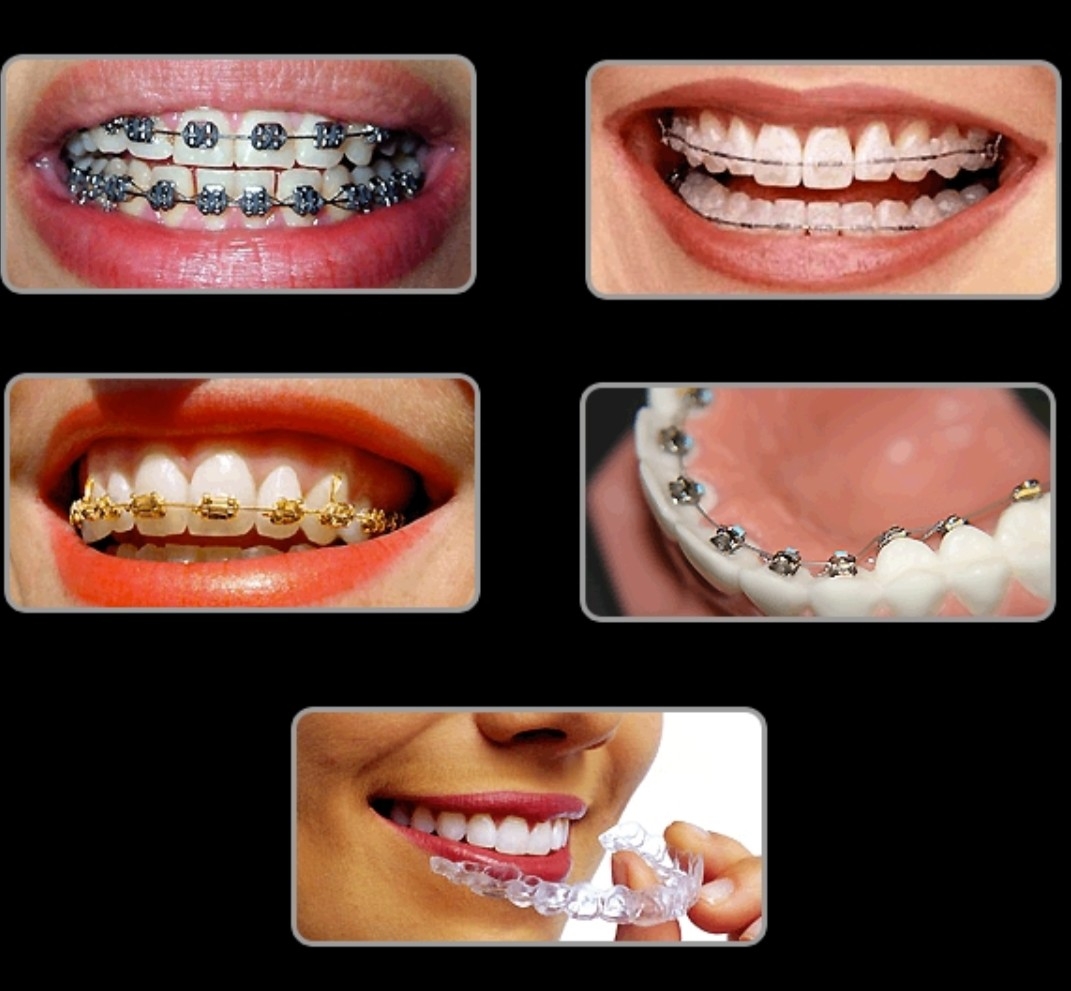 Dental braces are the best treatment option to ... main image