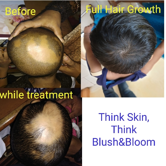 Alopecia areata.....
Think_Skin_Think_Blush_& _... main image