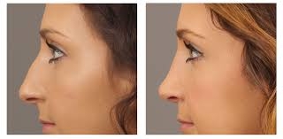 Liposuction 
Rhinoplasty 
Implants 
Tummytuck 
Gyn... main image