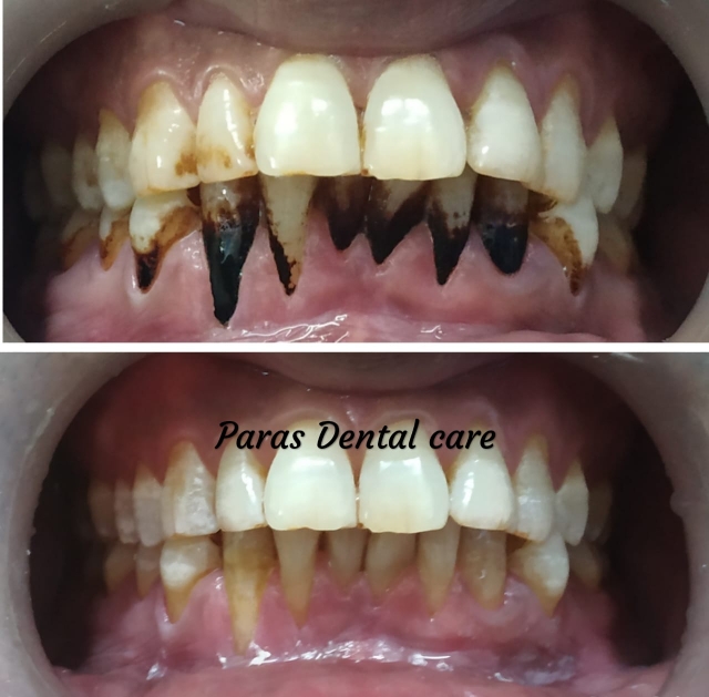 Professional cleaning of teeth is essential for... main image