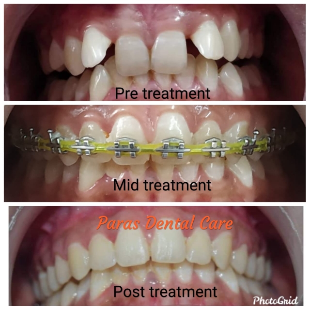 If your crooked teeth make you feel self-conscious... main image