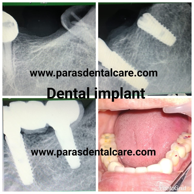 Dental implant is a titanium post placed into the ... main image