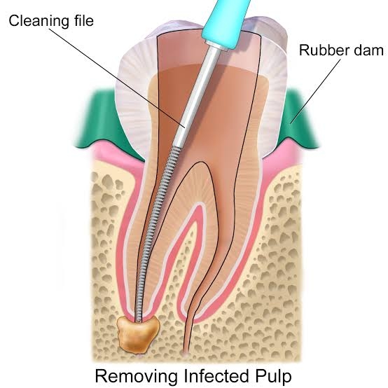 Root canal treatment is a procedure in which Ro... main image