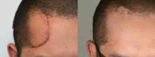 Scar revision....
Liposuction 
Rhinoplasty 
Implan... main image