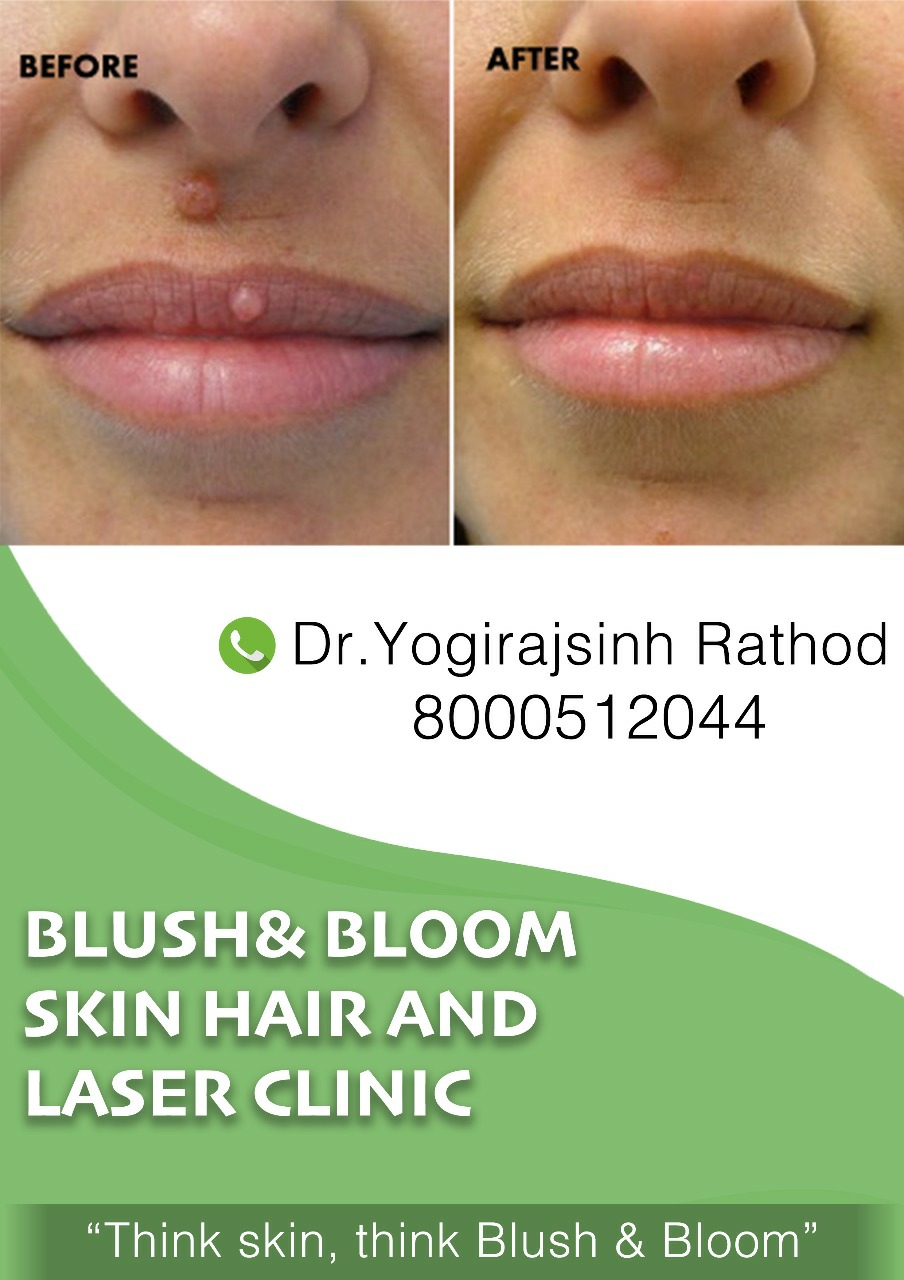 Mole removal without sutures.....
Think_Skin_Th... main image