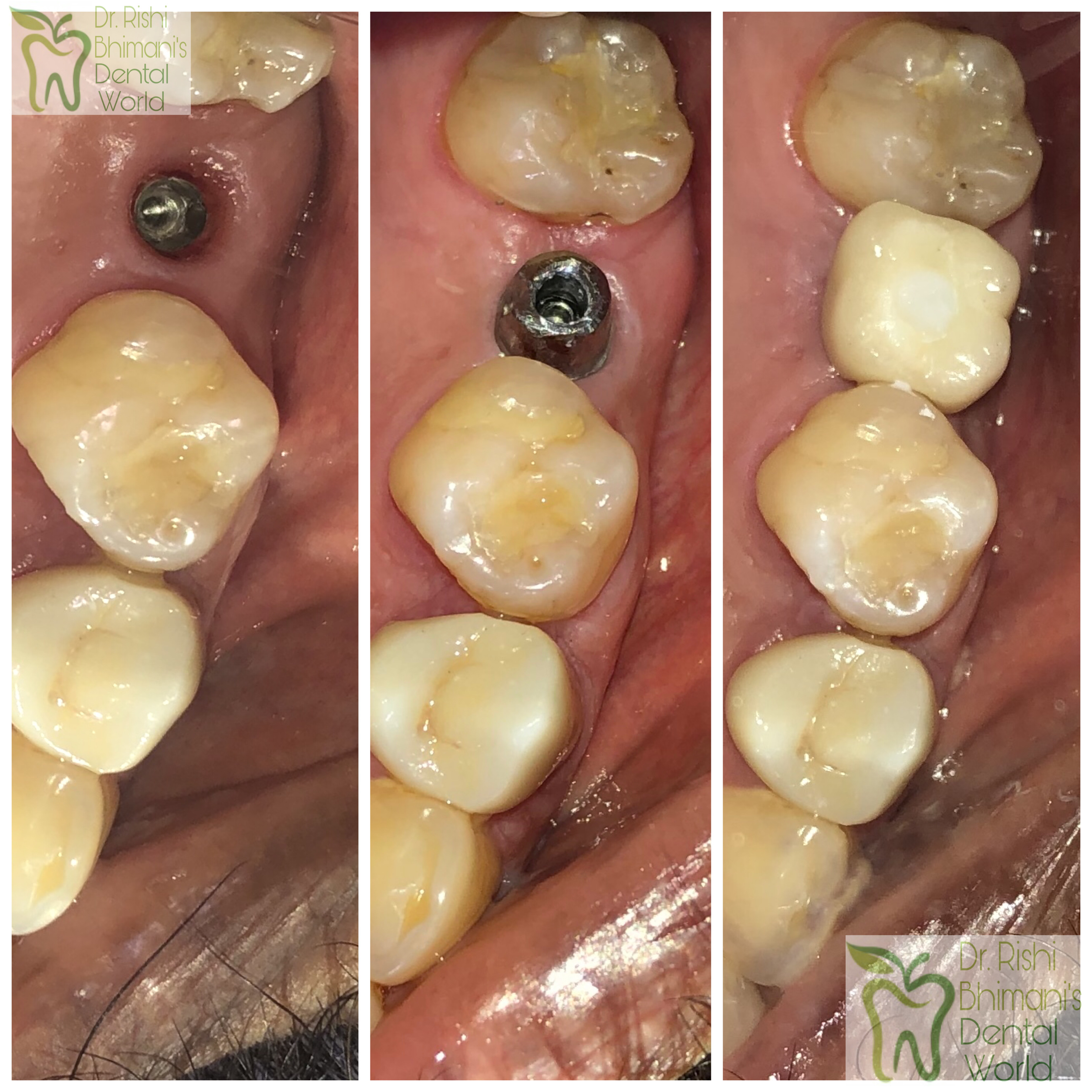 DENTAL IMPLANT
DENTAL IMPLANT is the best optio... main image