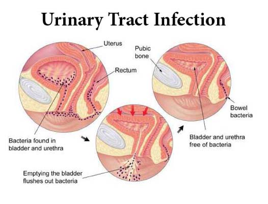 Urinary Tract Infection : A urinary tract infec... main image