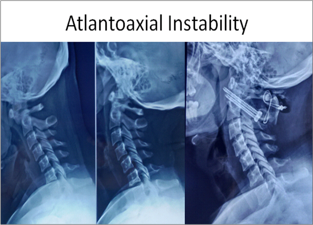Atlantoaxial Instability Atlantoaxial Instability
