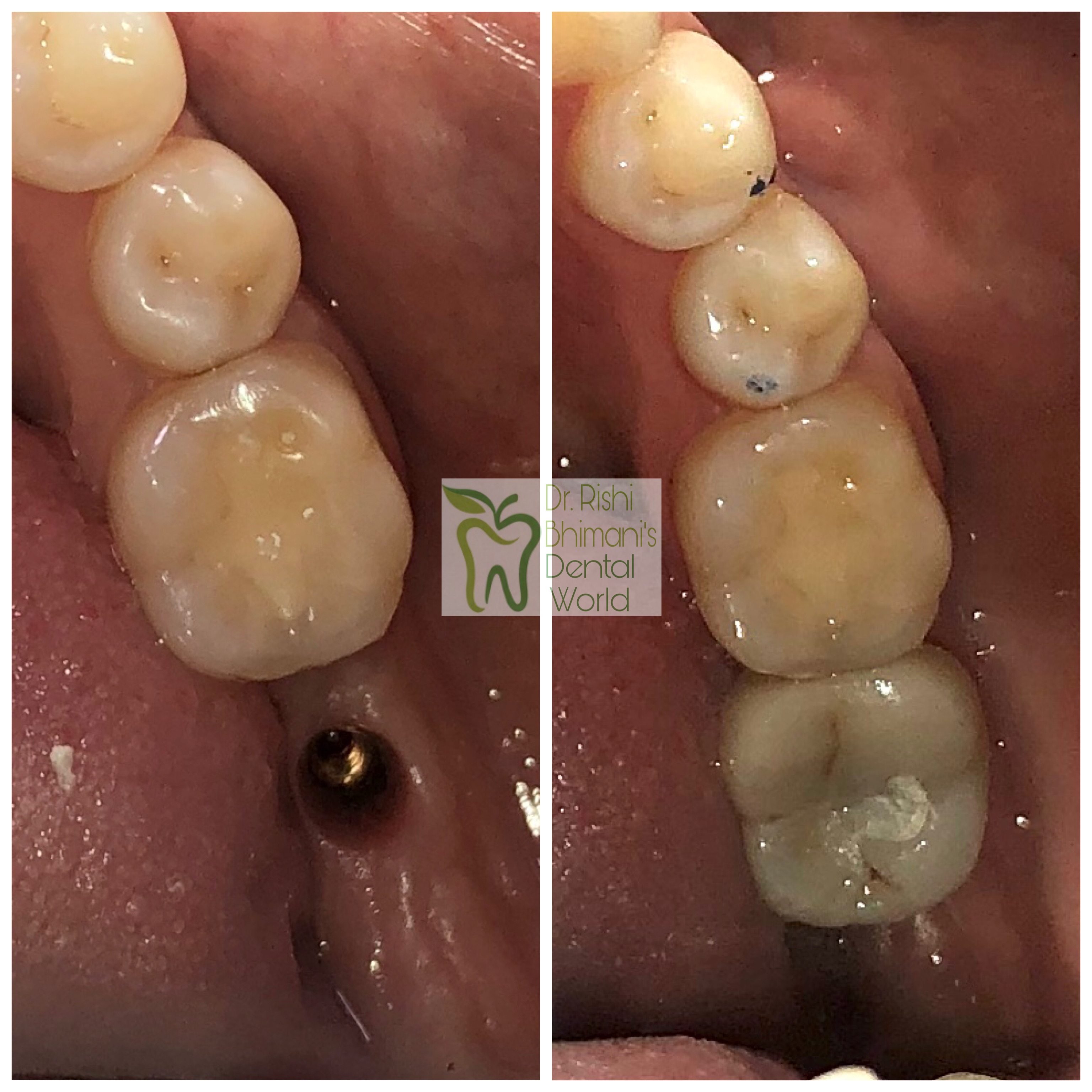 DENTAL IMPLANTS
Missing teeth can be replaced b... main image