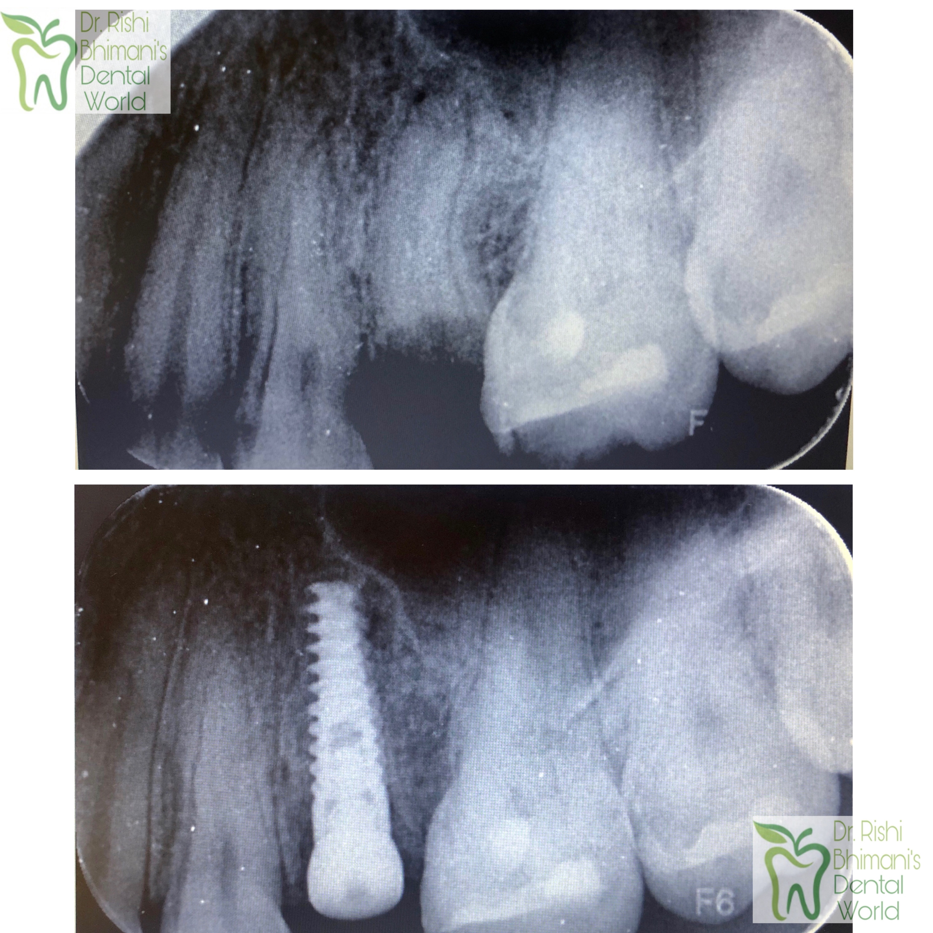 IMMEDIATE DENTAL IMPLANT
DENTAL IMPLANTS can re... main image